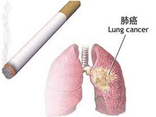 肺(癌)肿瘤的治疗及应该做哪些检查
