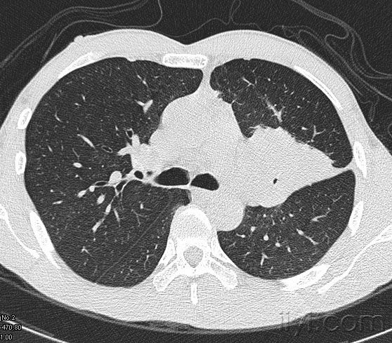 周围型肺癌的早期治愈率是多少?