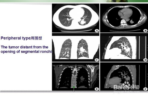 肺癌晚期发烧怎么办