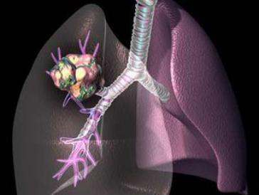 肺癌骨转移治疗方法?